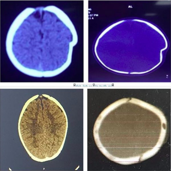 Ngã từ xe tập đi, bé gái 8 tháng tuổi bị lún sọ não