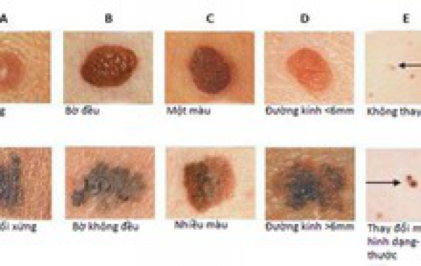 Những vị trí mọc nốt ruồi có thể tiến triển thành ung thư