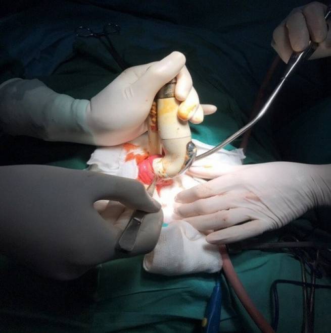 Rửa vệ sinh, nam thanh ni&ecirc;n bị đầu v&ograve;i xịt bồn cầu lọt s&acirc;u v&agrave;o hậu m&ocirc;n