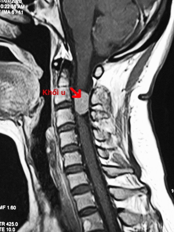 Cân não với ca phẫu thuật khối u chèn ép tủy cổ