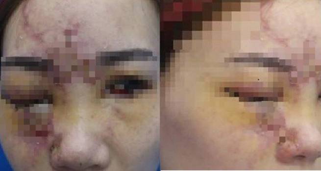 Li&ecirc;n tiếp m&ugrave; mắt sau ti&ecirc;m filler kh&ocirc;ng đ&uacute;ng chỗ
