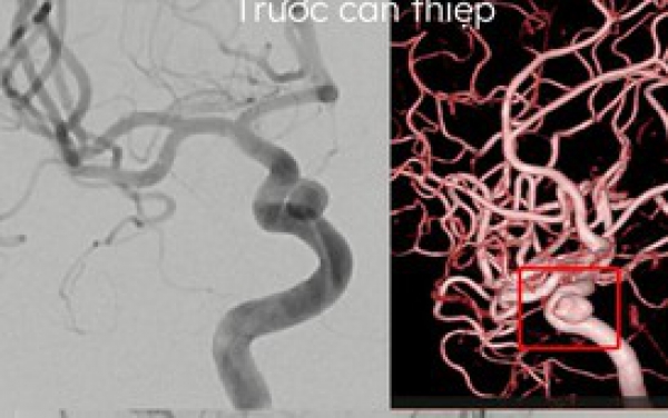 Tiết kiệm cả trăm triệu đồng cho ca bệnh suýt đột quỵ