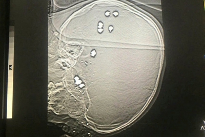 Bé trai 6 tuổi bị 11 viên đạn bi găm vào đầu