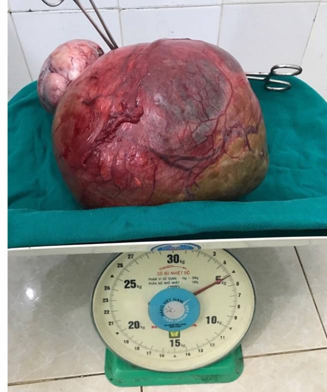 Ph&acirc;̃u thu&acirc;̣t thành c&ocirc;ng kh&ocirc;́i u nang bu&ocirc;̀ng trứng nặng 5kg