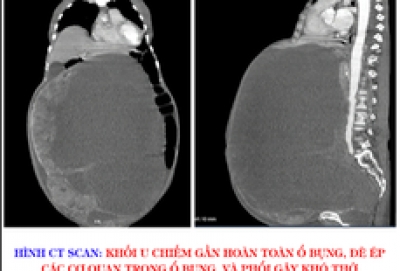 Lấy khối u nặng đến 30 kg trong ổ bụng người phụ nữ ra ngoài
