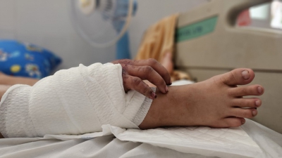 Gh&eacute;p b&agrave;n tay v&agrave;o ch&acirc;n cho c&ocirc; g&aacute;i 18 tuổi mang song thai để chờ ng&agrave;y nối lại